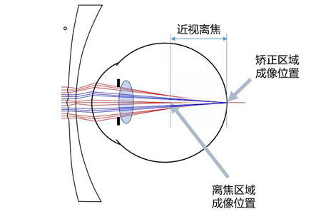 周边离焦镜片原理是什么?