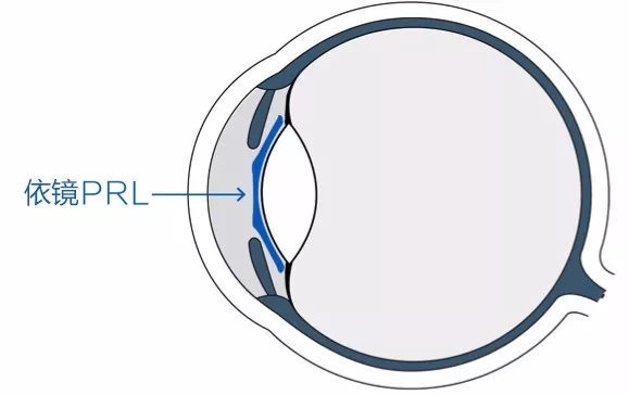 依镜prl适合多少度数的人做