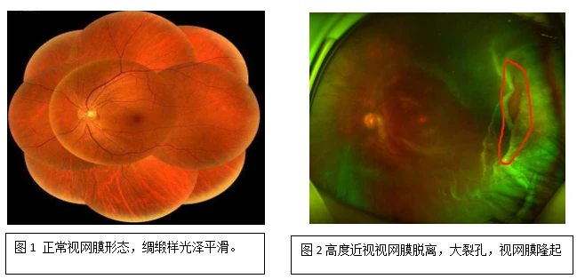 高度近视定期检查很有必要