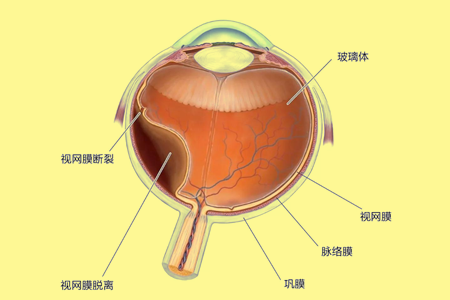 视网膜色素变性是什么样的眼病？