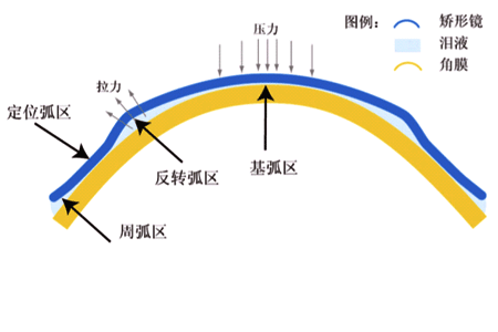 家长必知！角膜塑形镜需要长期佩戴吗？