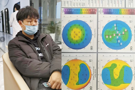 合肥ICL晶体植入手术多少钱？