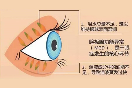 什么是干眼SPA？治疗流程有哪些？
