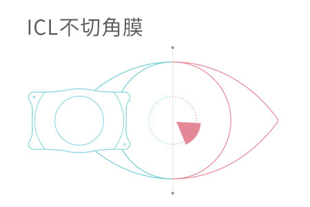 近视200散光200能做icl手术吗？答案在这里
