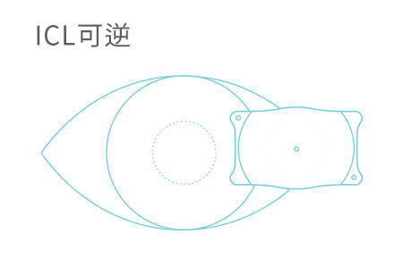 高度近视做icl手术有什么风险吗？必须知道