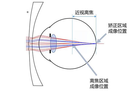 周边离焦眼镜好不好？一看就懂