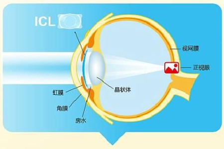 ICL人工晶体植入术的价钱是多少？