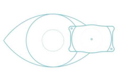 ICL人工晶体植入术有哪些缺点？