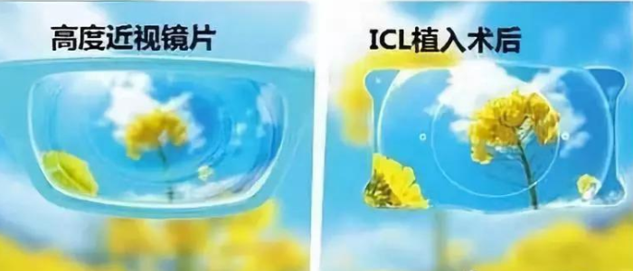 ​哪些近视眼的矫正手术更值得推荐呢？