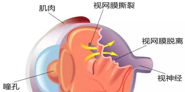沃瑞眼科为您解读全飞秒近视手术条件