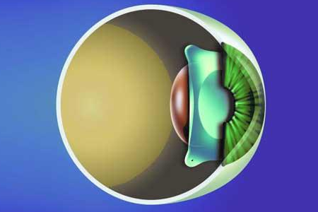 觉得有了晶体植入手术就不想保护眼睛怎么办？