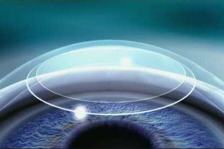 全飞秒激光近视手术和半飞秒激光近视手术哪个对角膜的损伤大？