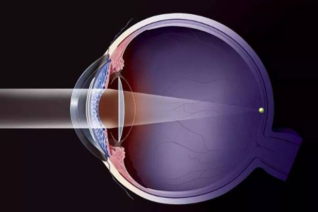 1000以上的近视怎么办？还能做近视手术嘛？