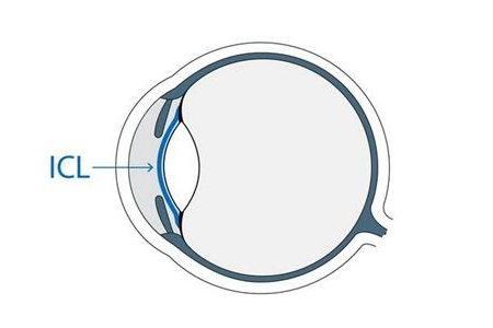 做ICL晶体植入术矫正视力是否是好的选择？有哪些利弊？