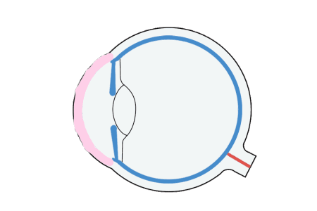 ICL植入晶体矫正视力效果好吗？