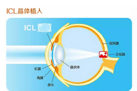ICL人工晶体植入手术后遗症多不多？