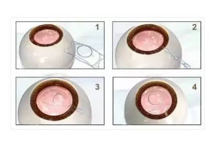 ICL人工晶体植入手术时间长吗？需要哪些准备？