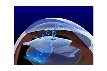 合肥ICL手术对视网膜有要求吗？