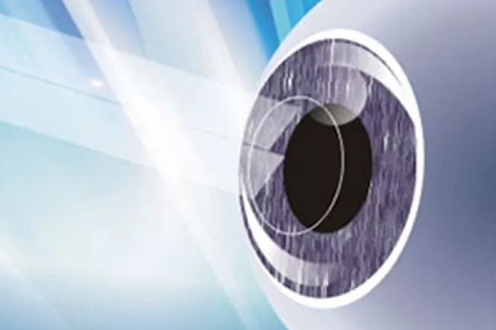 全飞秒视力矫正手术术后注意事项有哪些？