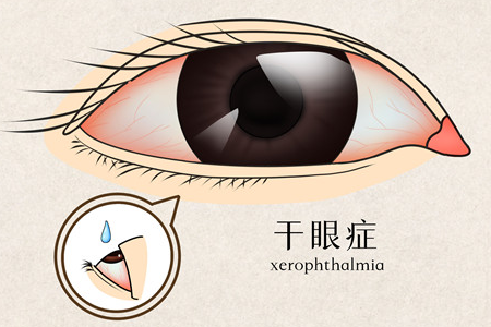 青少年干眼症是怎么引起的呢？