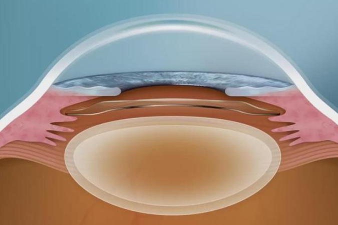 高度近视晶体植入后遗症有哪些可能？