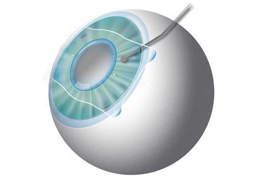 近视人工晶体手术后能喝酒吗？