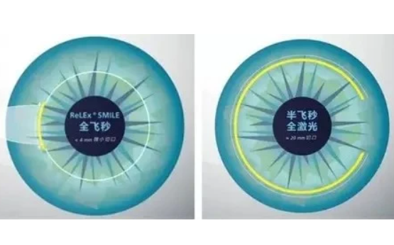 近视激光全飞秒和半飞秒的区别体现？