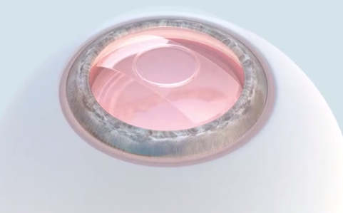 ICL多少钱？在合肥做个ICL一共花多少钱？