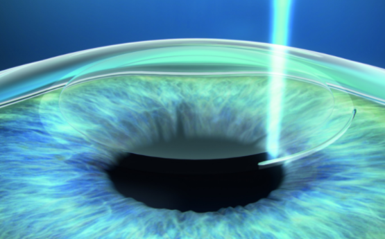 角膜薄的情况做近视眼手术好吗?