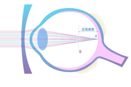 离焦镜眼镜是什么？有什么作用？