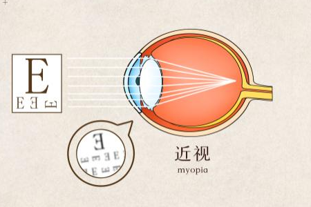 近视多少度会失明？能不能治好？