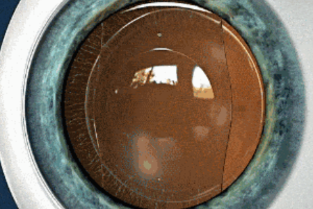 ICL人工晶体植入手术后眼睛会有异物感吗？会不会出现排斥反应？