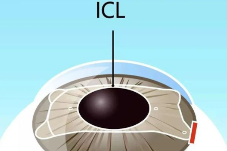 近视手术ICL晶体植入手术检查有什么要求?
