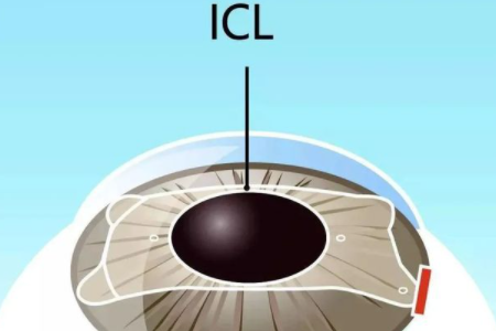 ICL晶体植入只有20年寿命吗？