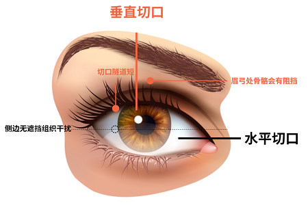 ICL手术时该选择水平切口还是垂直切口？