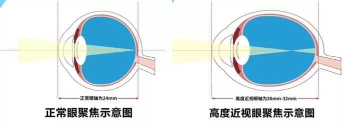 合肥近视手术,近视和眼轴有什么关系?